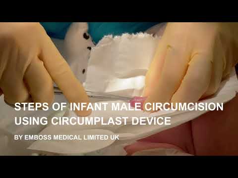 Infant male circumcision with Circumplast device- Best ring